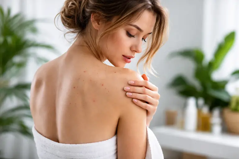 Acné corporal: cómo eliminar granos en espalda y pecho