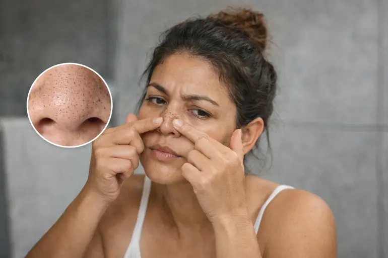 Por qué aparecen puntos negros y cómo eliminarlos