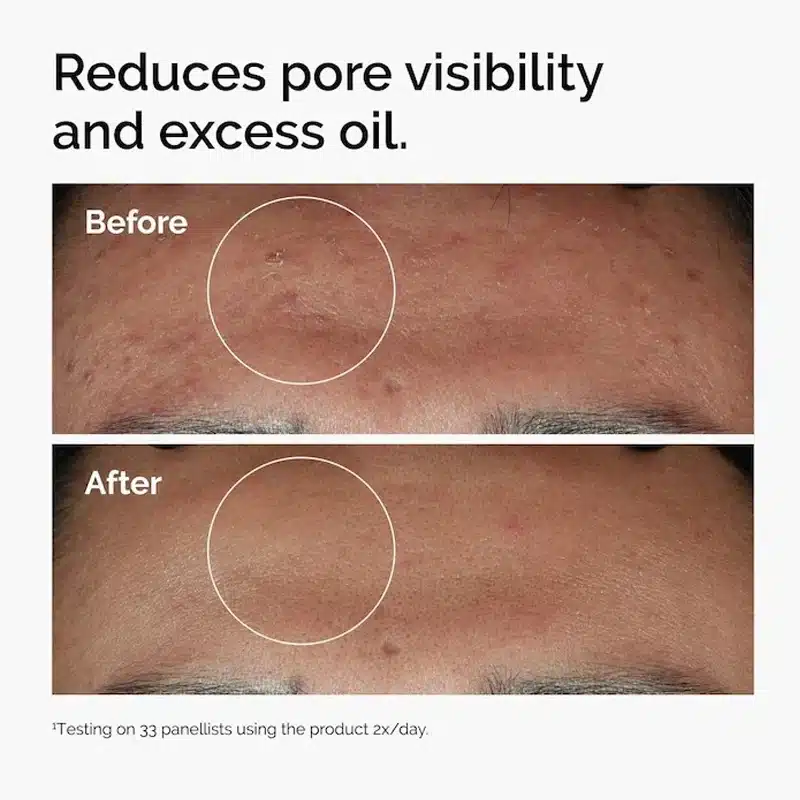 The Ordinary Niacinamide 10% + Zinc 1% Serum 30ml - Imagen 6